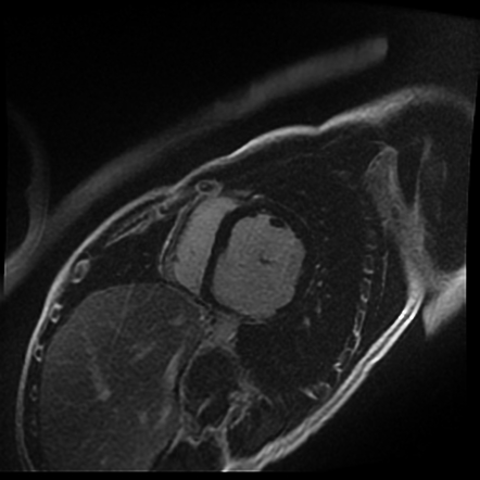 Dilated Cardiomyopathy With Left Ventricular Aneurysm Image