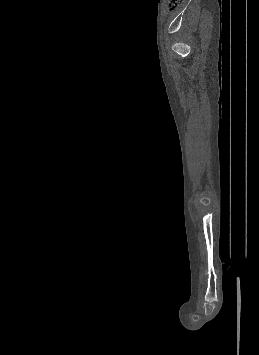 Bilateral Fibular Hemimelia Type Ii Image Radiopaedia Org