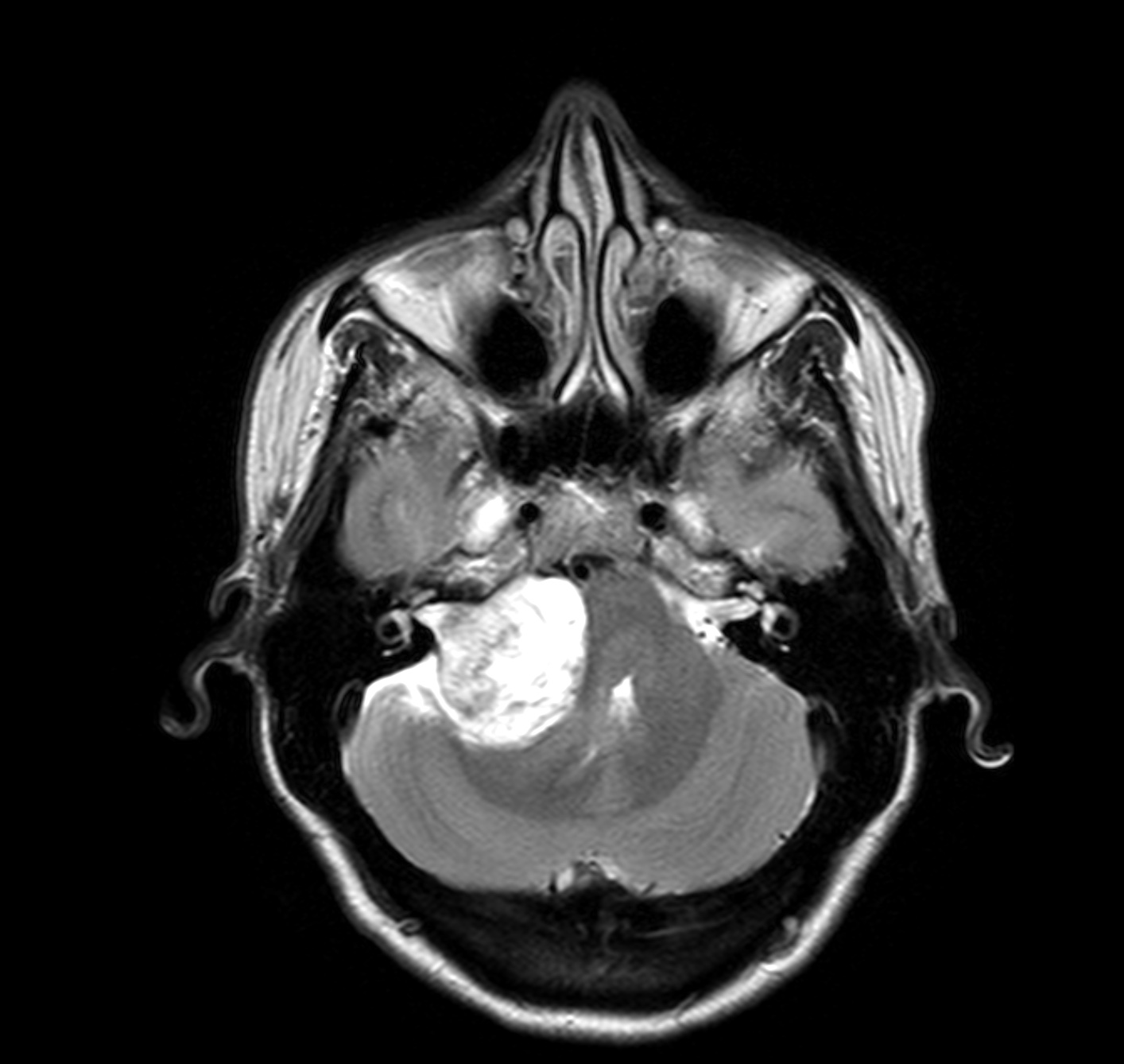 Vestibular Schwannoma Image Radiopaedia Org