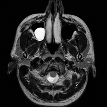 Mucous Retention Cyst Radiology Case Radiopaedia Org