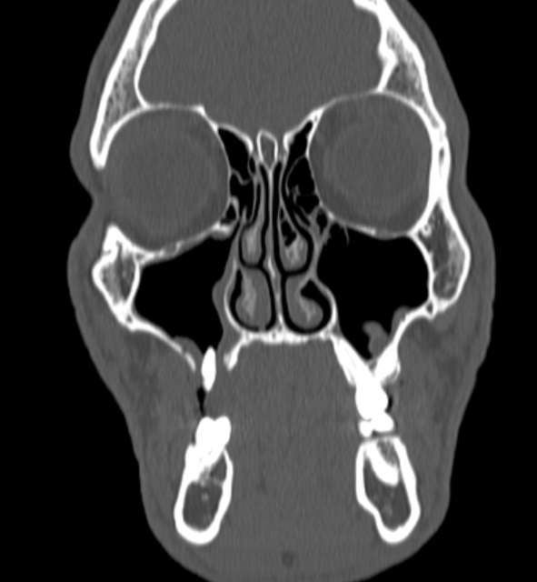 Oro Antral Fistula With Retained Root Image Radiopaedia Org