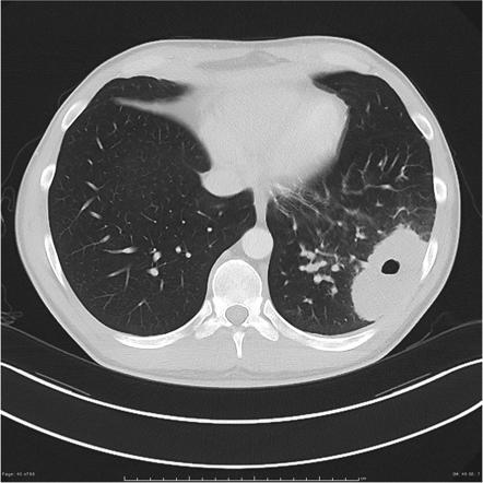 Cavitating Lung Cancer Radiology Case Radiopaedia Org