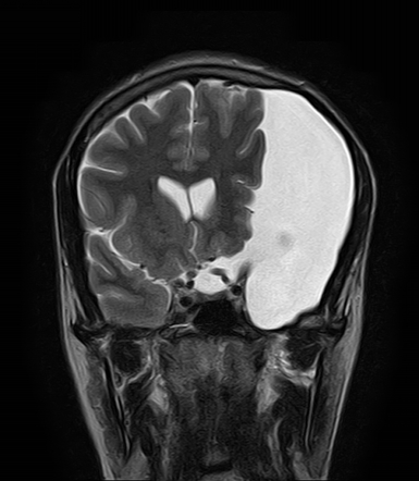 Compressive Arachnoid Cyst Middle Cranial Fossa Radiology Case