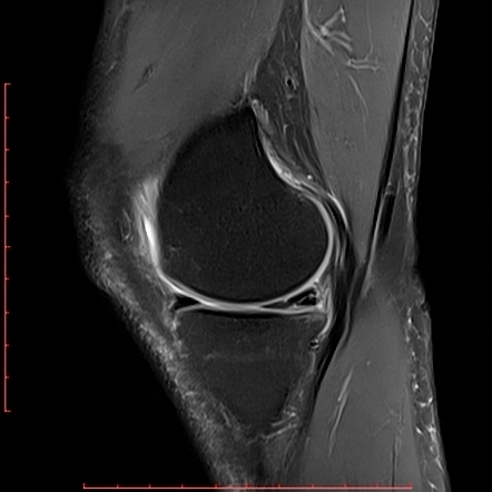 Complex Meniscal Tear Radiology Reference Article Radiopaedia Org