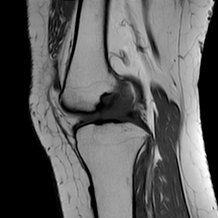 Anterior Cruciate Ligament Mucoid Degeneration And Ganglion Cyst