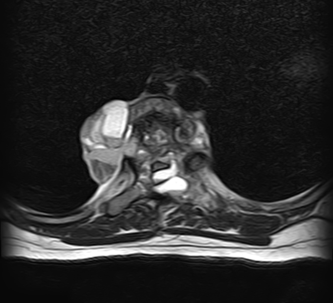 Aneurysmal Bone Cyst Spine Image Radiopaedia Org