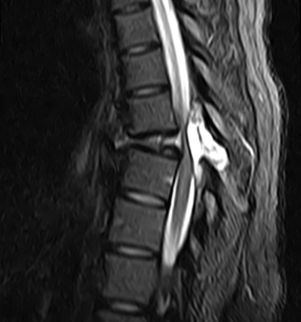 Aneurysmal Bone Cyst Spine Image Radiopaedia Org