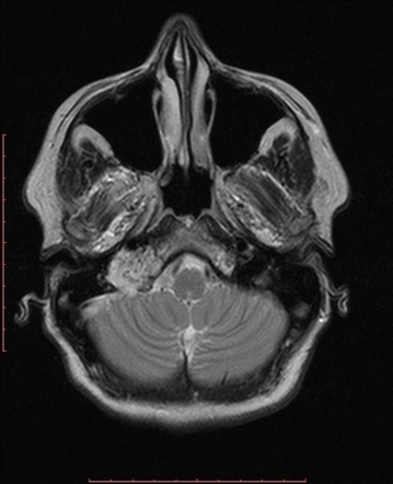 Jugular Paraganglioma Radiology Reference Article Radiopaedia Org