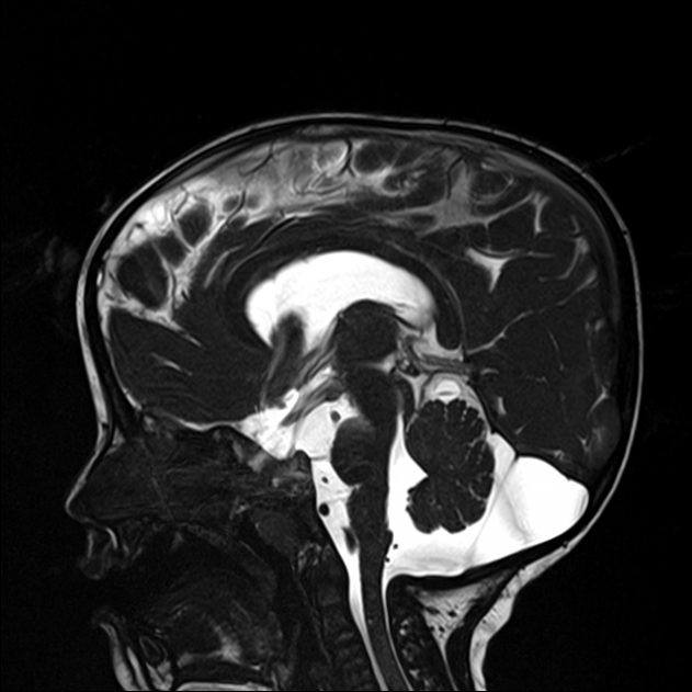 Bilateral Temporal Arachnoid Cysts Type III Image Radiopaedia Org