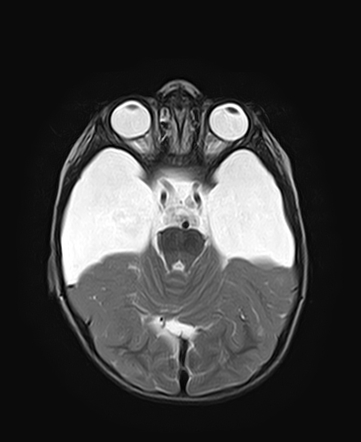 Bilateral Temporal Arachnoid Cysts Type Iii Radiology Case