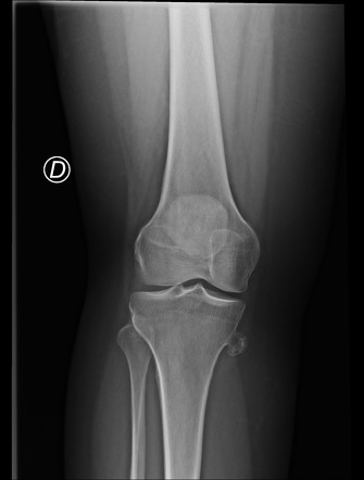 Osteochondroma Knee Image Radiopaedia Org