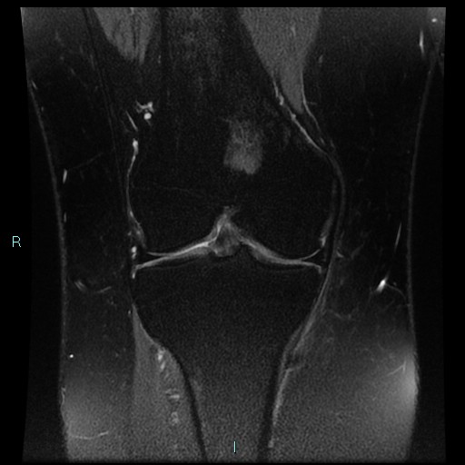 Osteochondroma Knee Image Radiopaedia Org