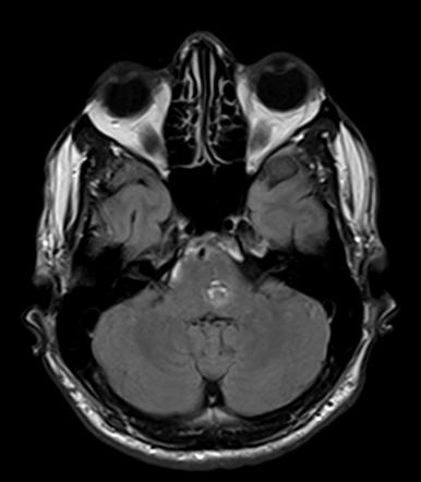 Brainstem Cavernoma Image Radiopaedia Org