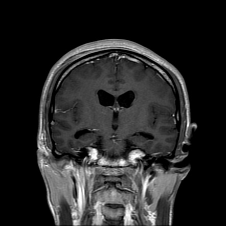 Pineal Germinoma Image Radiopaedia Org