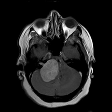 Vestibular Schwannoma Radiology Reference Article Radiopaedia Org