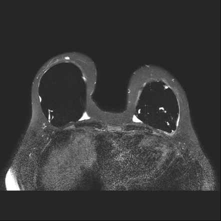 Intracapsular Breast Implant Rupture Image Radiopaedia Org