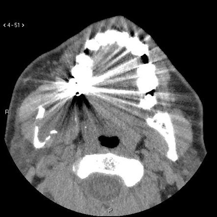 Keratocystic Odontogenic Tumor Image Radiopaedia Org