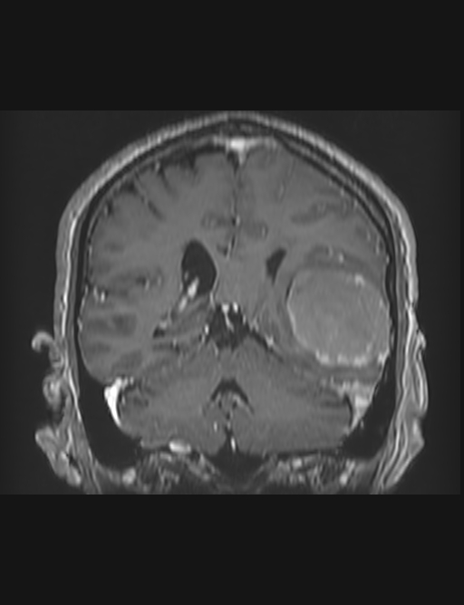 Meningioma Invading The Dural Venous Sinus Image Radiopaedia Org