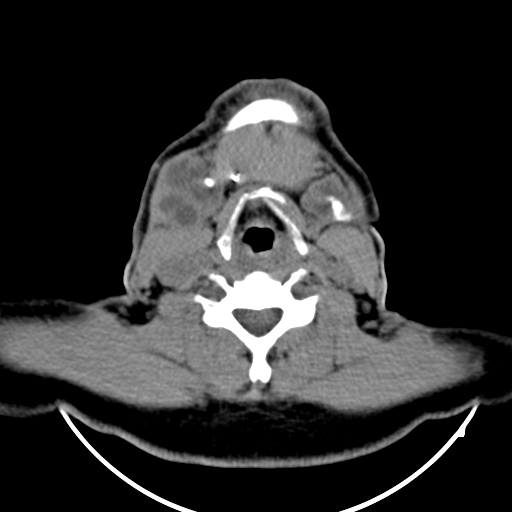 Bilateral Submandibular Sialolithiasis With Sialadenitis Image