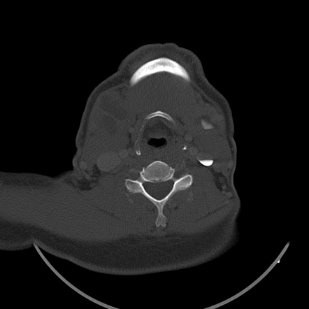 Bilateral Submandibular Sialolithiasis With Sialadenitis Image