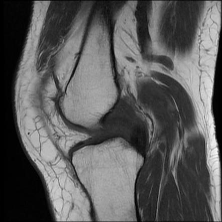 Medial Collateral Ligament Avulsion Injury Image Radiopaedia Org