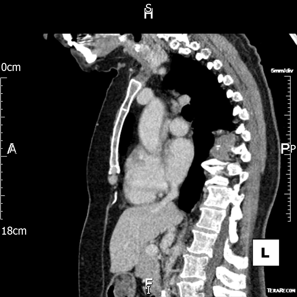 Malignant Pleural Mesothelioma Presenting As Perifissural Nodules