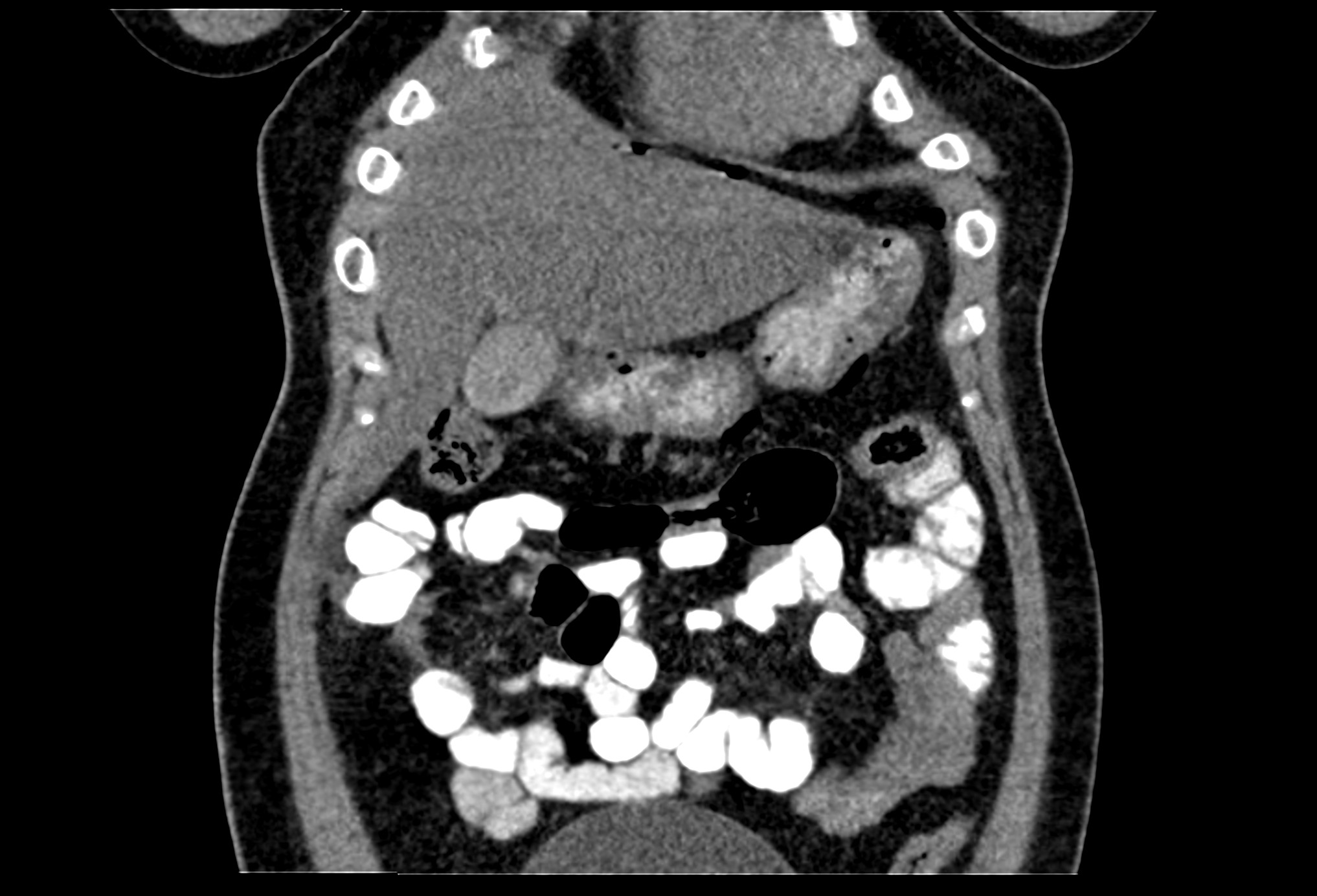 Perforated Duodenal Ulcer Image Radiopaedia Org