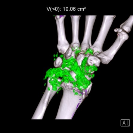 Gout Wrist Radiology Case Radiopaedia Org