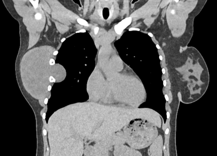 Intercostal Nerve Plexiform Neurofibroma Image Radiopaedia Org