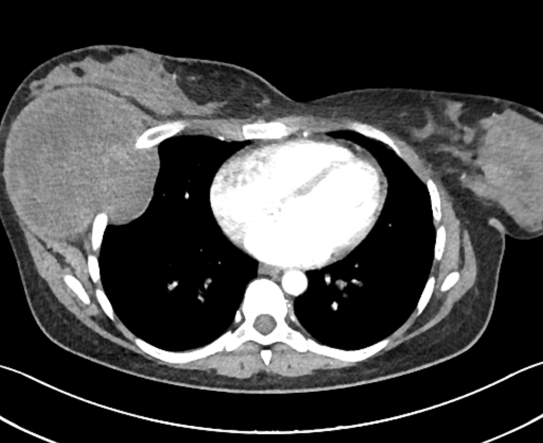 Intercostal Nerve Plexiform Neurofibroma Image Radiopaedia Org