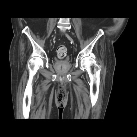 Fournier Gangrene Image Radiopaedia Org