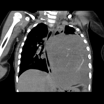 Pleuropulmonary Blastoma Image Radiopaedia Org