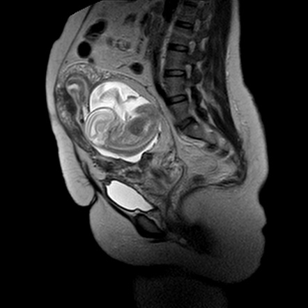 Cesarean Scar Ectopic Pregnancy Radiology Reference Article Radiopaedia Org