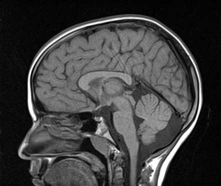 Subependymal Grey Matter Heterotopia And Bilateral Arachnoid Cysts