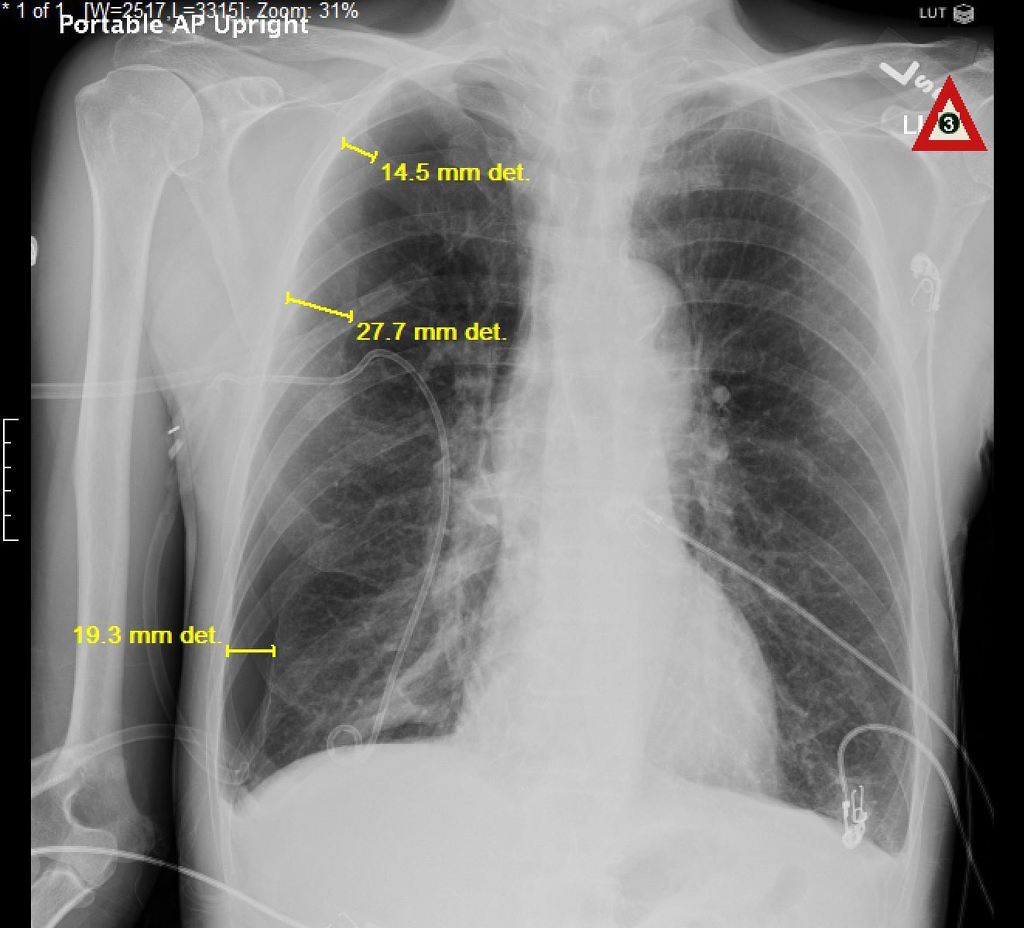 Pneumothorax X Ray