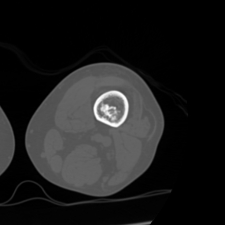 Enchondroma Femur Image Radiopaedia Org