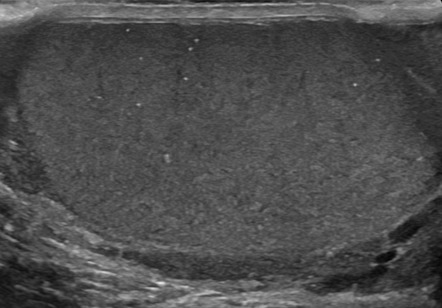 Testicular Microlithiasis Radiology Reference Article Radiopaedia Org