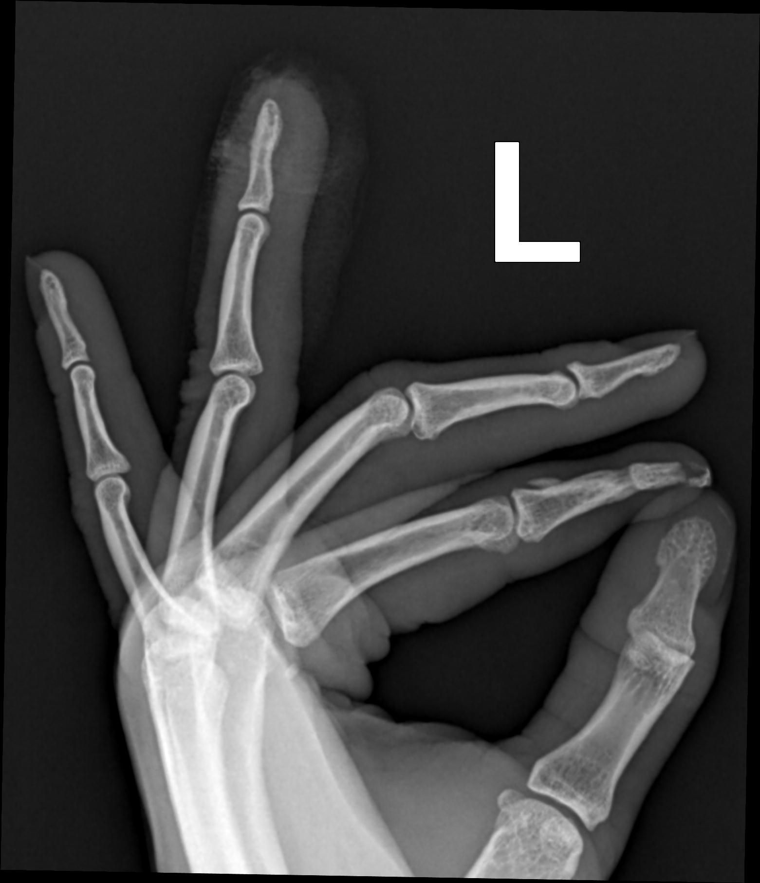 Distal Phalanx Fracture Image Radiopaedia Org