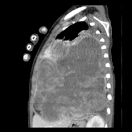 Pleuropulmonary Blastoma Image Radiopaedia Org