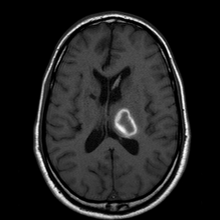 Hypertensive Intracerebral Hemorrhage Radiology Reference Article