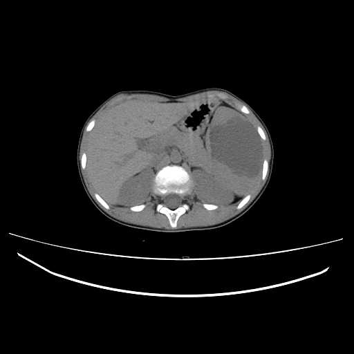 Splenic Lymphangioma Image Radiopaedia Org