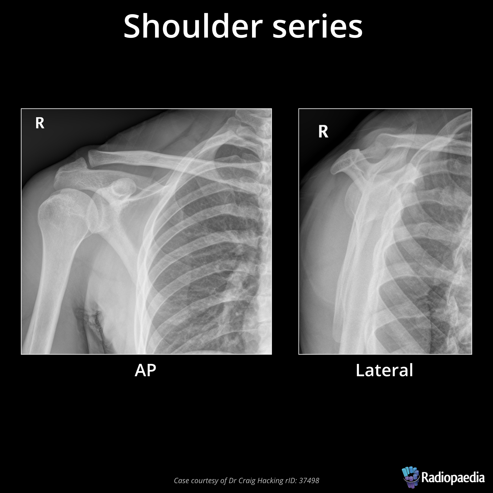 Right Shoulder X Ray Views At Anja Flores Blog