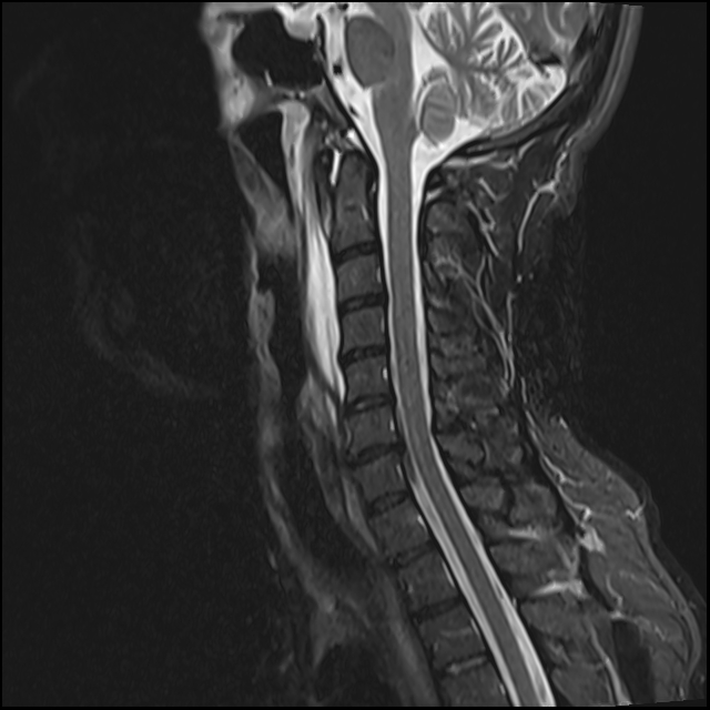 Acute Longus Colli Calcific Tendinitis Image Radiopaedia Org