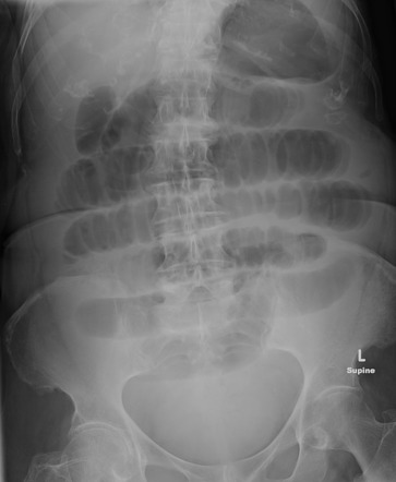 Small Bowel Obstruction On AXR Radiology Case Radiopaedia Org