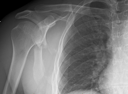 Scapular Fracture Radiology Case Radiopaedia Org