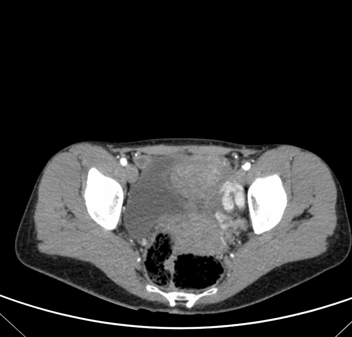 Paraganglioma Of Urinary Bladder Image Radiopaedia Org