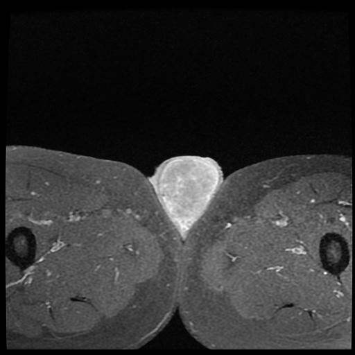 Testicular Seminoma Image Radiopaedia Org