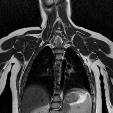 Bilateral Sprengel Deformity With Klippel Feil Syndrome Radiology