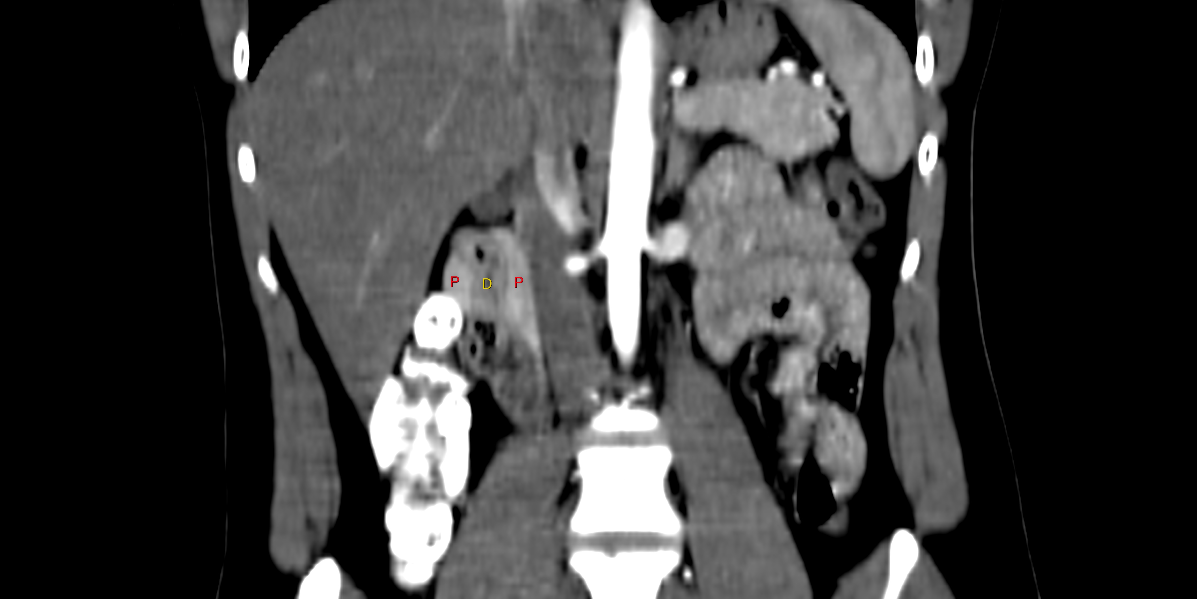 Complete Annular Pancreas Image Radiopaedia Org