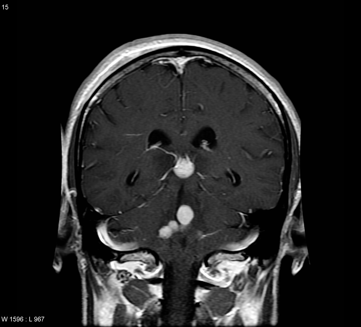 Primary CNS Lymphoma Intraventricular Image Radiopaedia Org